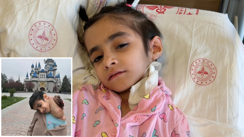 Eskişehir’de 8 Yaşındaki Fatma’nın Boynundaki 3 Kiloluk Kitle 6,5 Saatlik Ameliyatla Alındı