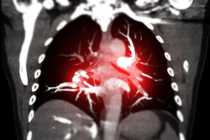 Pulmoner Arteriyel Hipertansiyon Sessiz İlerliyor Kalp Yetmezliğine Kadar Götürebiliyor