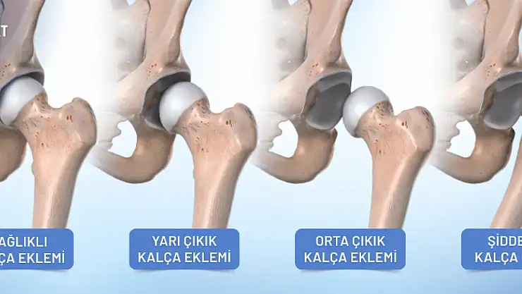 Bebeklerde Bacak Boyu Farkına Dikkat! Kalça Çıkığının İlk Belirtisi Olabilir