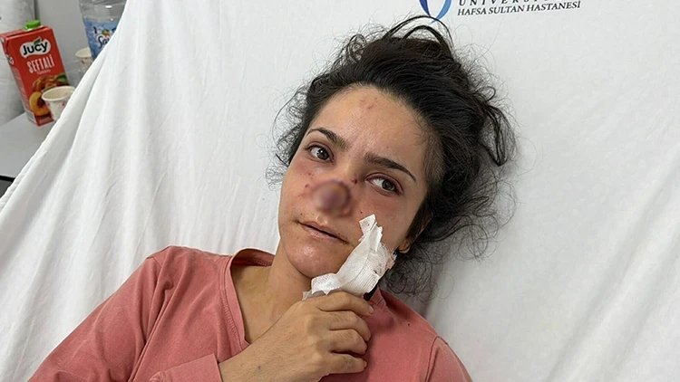 Manisa'da Eşinin Saldırısında Burnu Kopan Kadın Konuştu: 