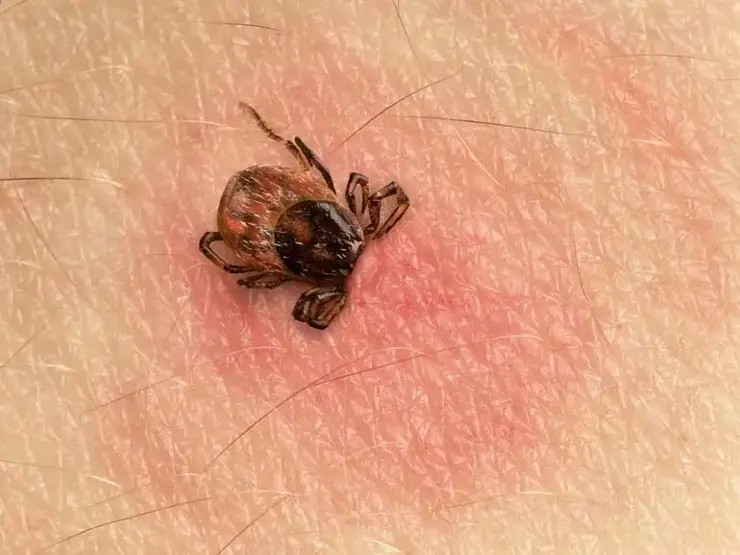 Kene Isırığı Sonrası Halka Şeklindeki Kızarıklığa Dikkat