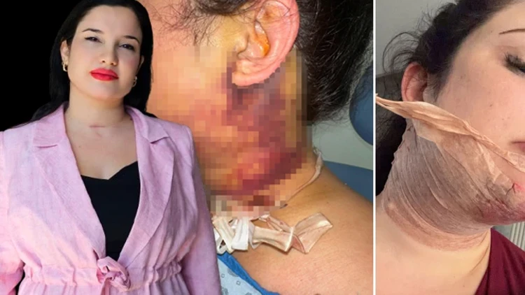 Antalya’da Estetik İşlem Sonrası Yoğun Bakım: Gonca Uzhan 5 Milyon TL’lik Tazminat Davası Açtı